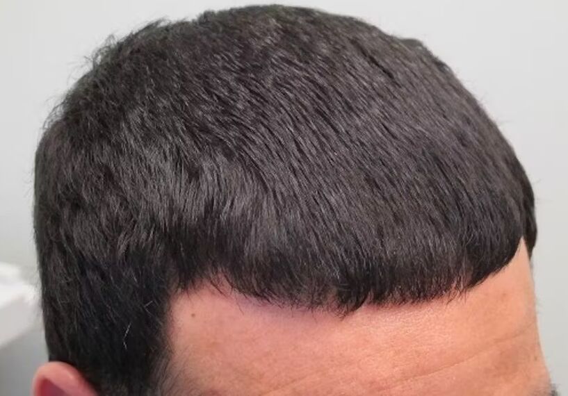 Ho curato la verdoxidil per la perdita di capelli