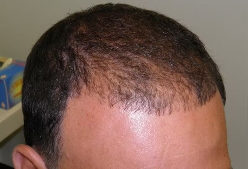 Perdita di capelli prima di usare verdoxidil
